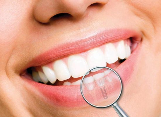 A evolução dos implantes dentários
